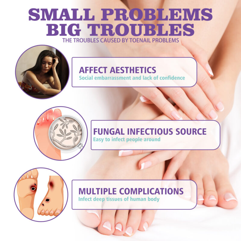 Natural Nail Care Spray for Ingrown, Yellowing & Thickening Nails - Image 3