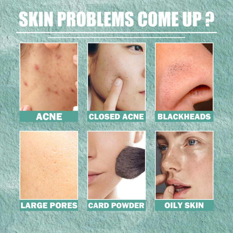 Cystic Acne Face Cream for Closed Pimples & Acne Marks with Natural Ingredients - Image 3