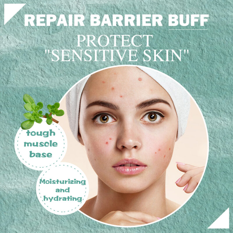 Cystic Acne Face Cream for Closed Pimples & Acne Marks with Natural Ingredients - Image 4