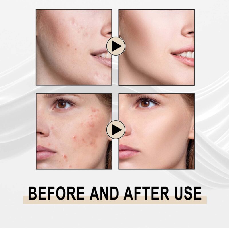 Lactose Essence: Exfoliate Blackheads, Reduce Pores, Cleanse & Moisturize - Image 4