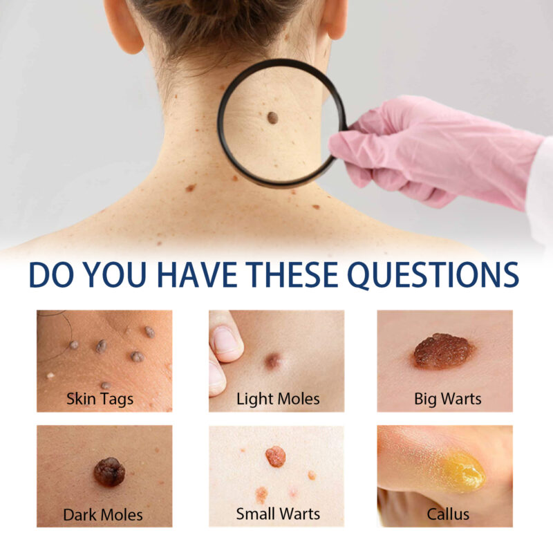 Wart & Skin Tag Removal Kit with Natural Plant-Based Lotion - Image 3