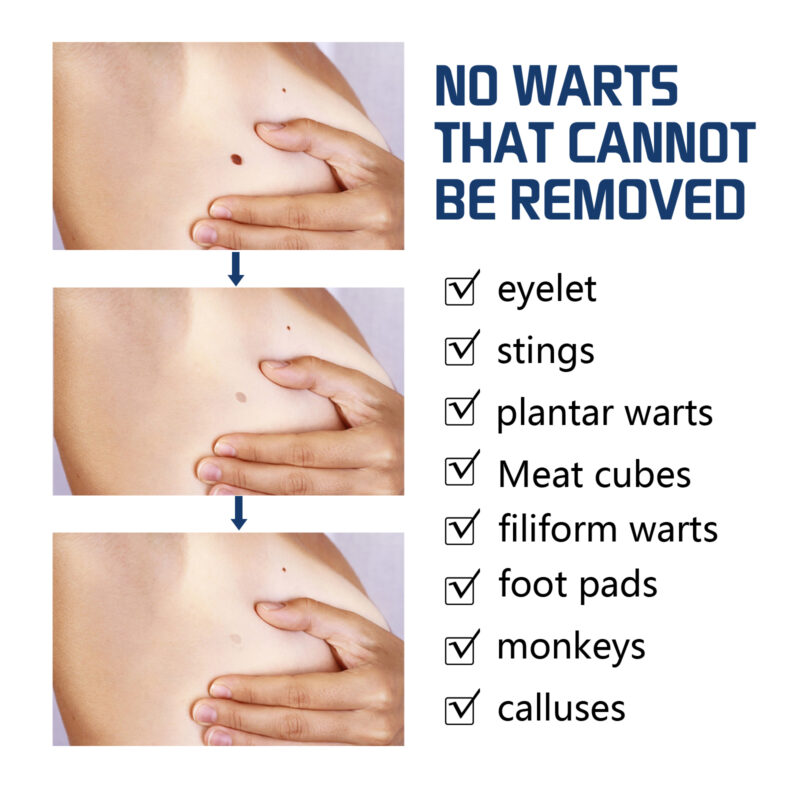 Wart & Skin Tag Removal Kit with Natural Plant-Based Lotion - Image 4