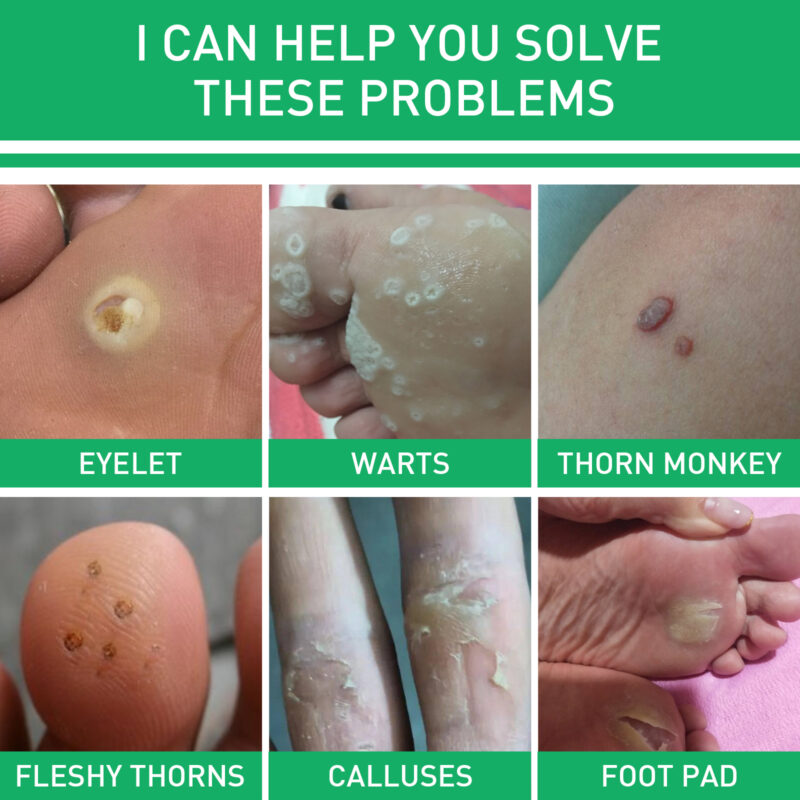 Natural Foot Corns Smoothing Lotion with Herbal Ingredients - Image 3