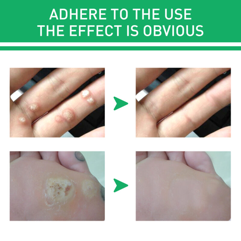 Natural Foot Corns Smoothing Lotion with Herbal Ingredients - Image 4