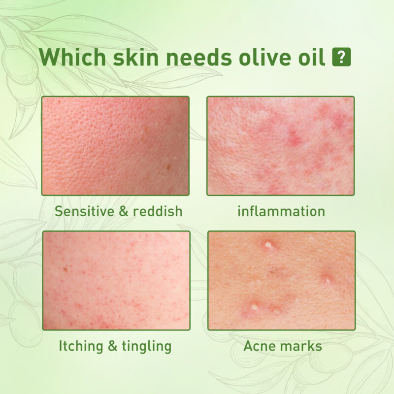 Natural Acne Essential Oil - Moisturize, Fade Marks, Balance Skin - Image 3
