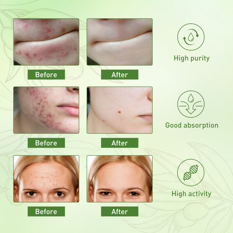 Natural Acne Essential Oil - Moisturize, Fade Marks, Balance Skin - Image 4