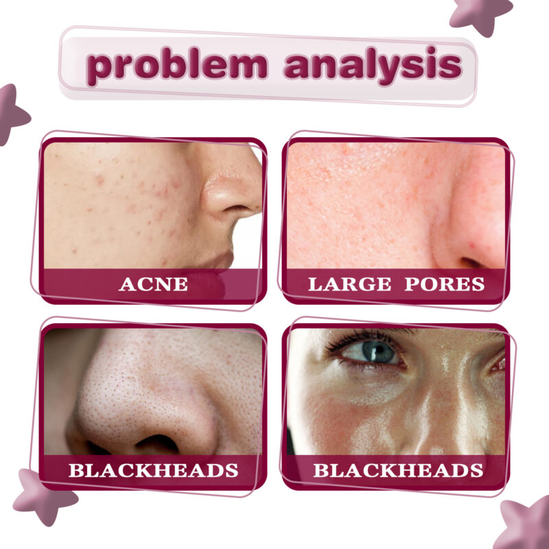 Acid Essence for Minimized Pores, Reduced Blackheads & Brighter Skin - Image 3