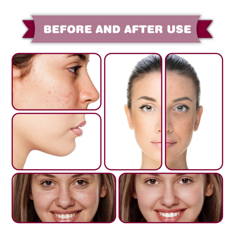 Acid Essence for Minimized Pores, Reduced Blackheads & Brighter Skin - Image 4