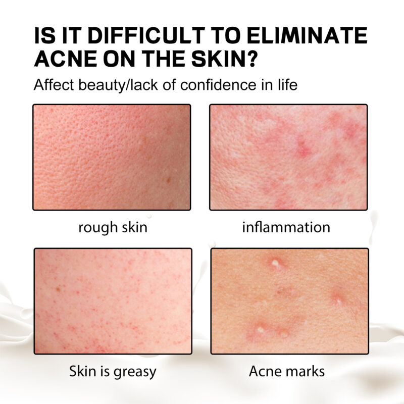 Back Silk Soap - Gentle Body Cleanser for Acne-Prone Skin - Image 3