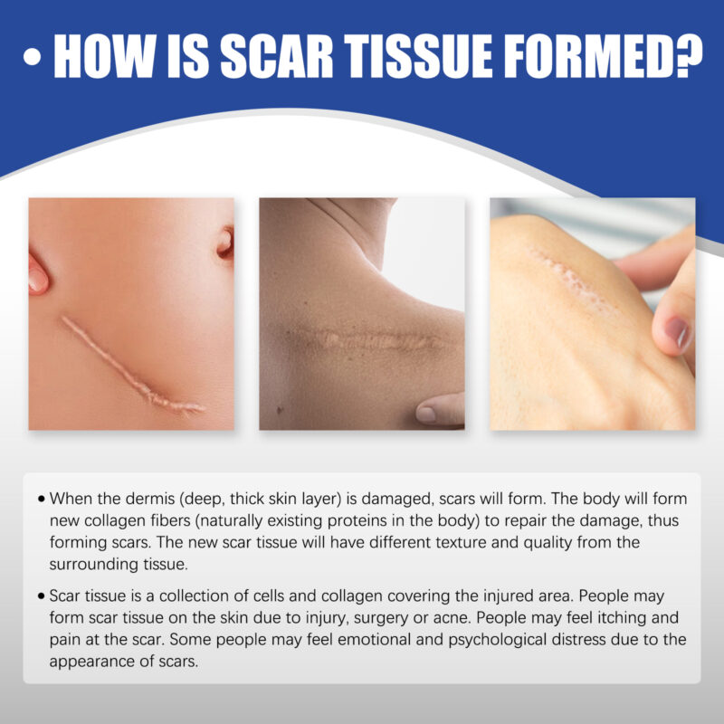 Silicone Scar Tape for Smoother Texture & Skin Comfort - Image 3