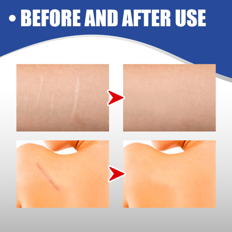 Silicone Scar Tape for Smoother Texture & Skin Comfort - Image 4
