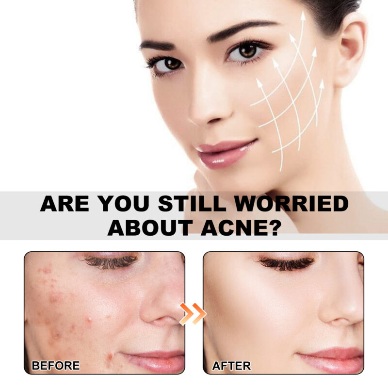 Sea Life Pattern Acne Patches for Concealing, Soothing, and Nourishing Skin - Image 3