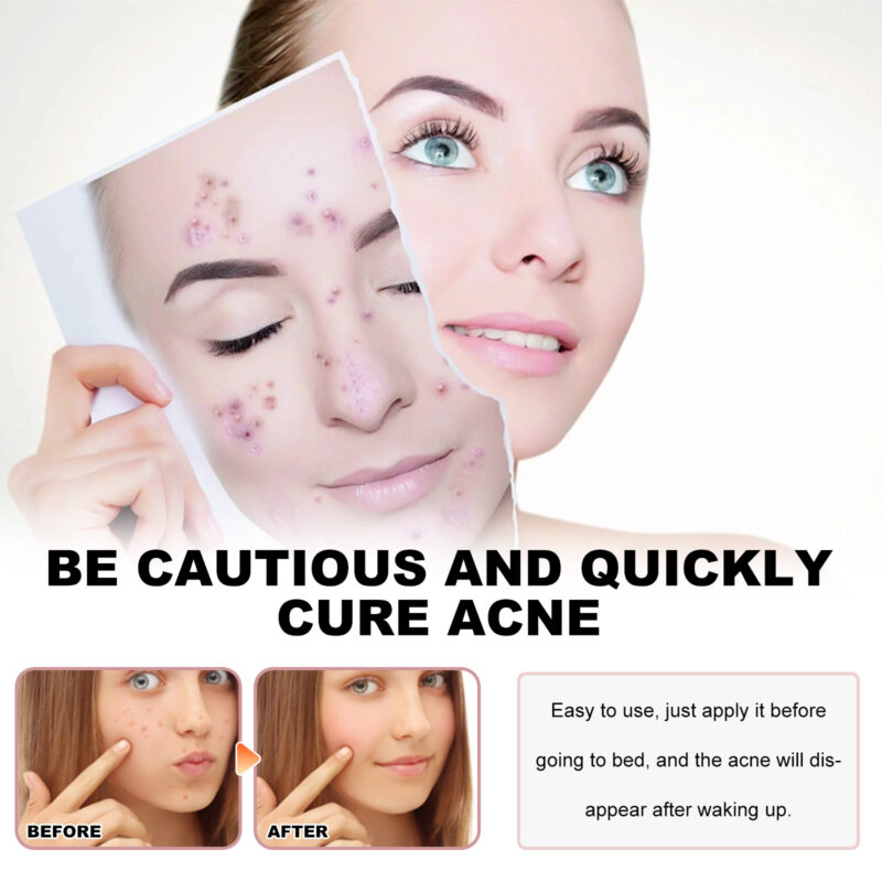 Sea Life Pattern Acne Patches for Concealing, Soothing, and Nourishing Skin - Image 4
