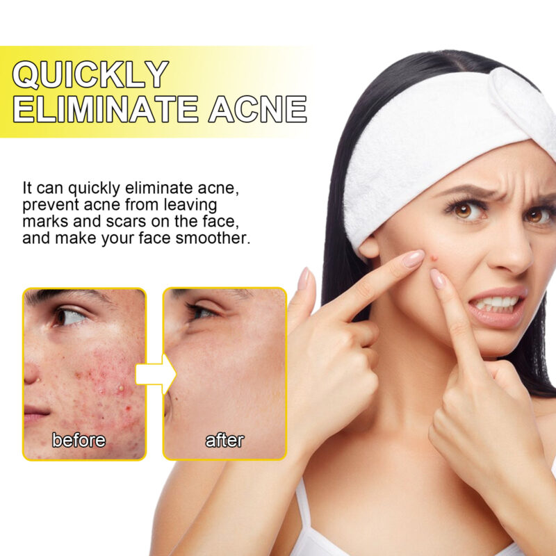 Acne Hydrocolloid Patches for Delicate Skin - Cleansing, Blackhead Removal - Image 4