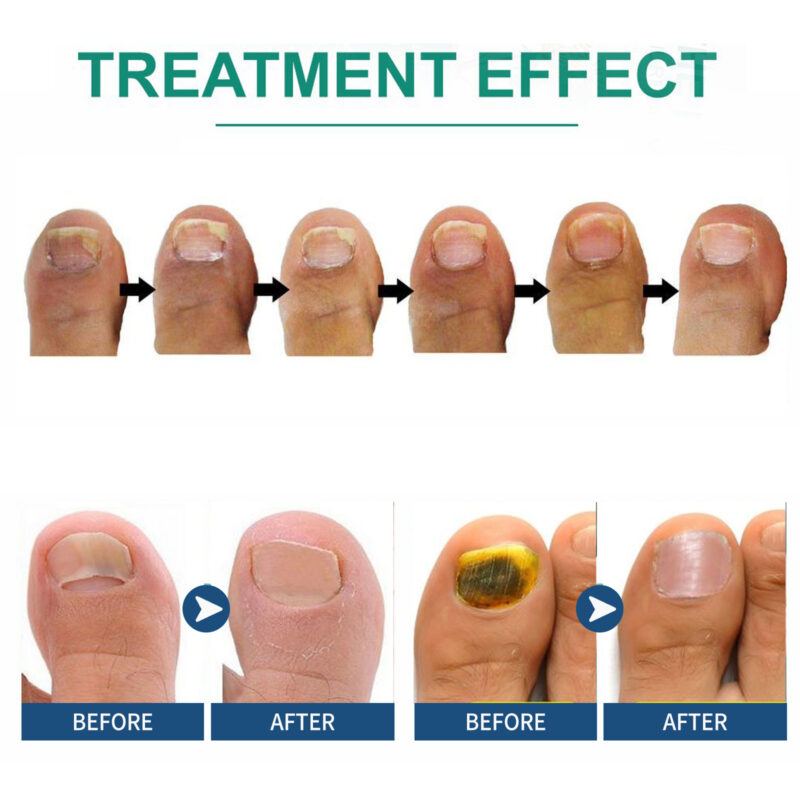 Natural Nail Treatment Essence - Strengthening & Brightening Hand Foot Care - Image 3