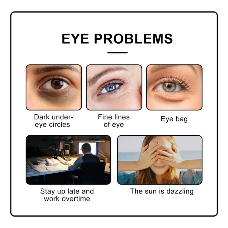 Puffiness and Dark Circles