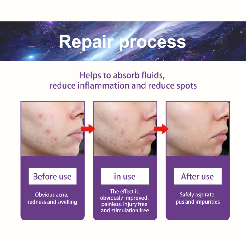 Acne Patches with Salicylic Acid & Tea Tree Oil - Waterproof, Breathable Skin Care - Image 4