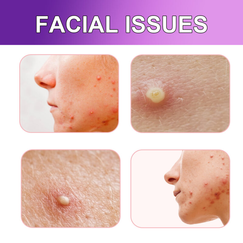 Acne Patches for Pore Balancing, Blemish Lightening & Daily Care - Image 3