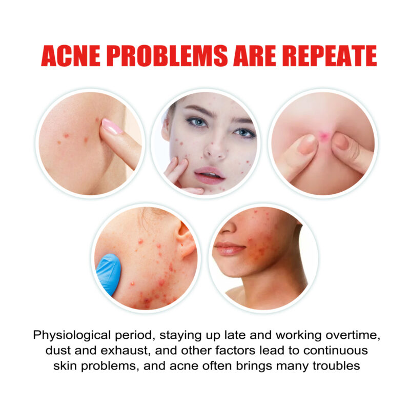 Hydrocolloid Pimple Patch for Blemish Care & Skin Protection - Image 3