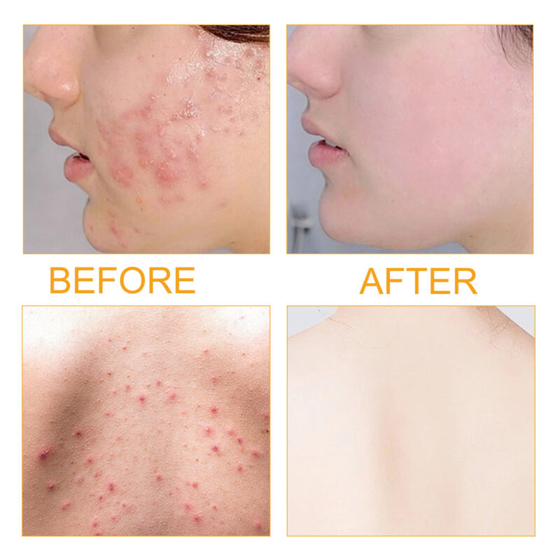 Plant-Based Acne Serum for Acne Marks & Moisturizing Skin Care - Image 3