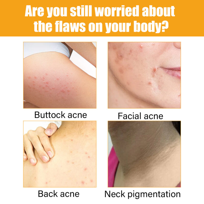 Plant-Based Acne Serum for Acne Marks & Moisturizing Skin Care - Image 4