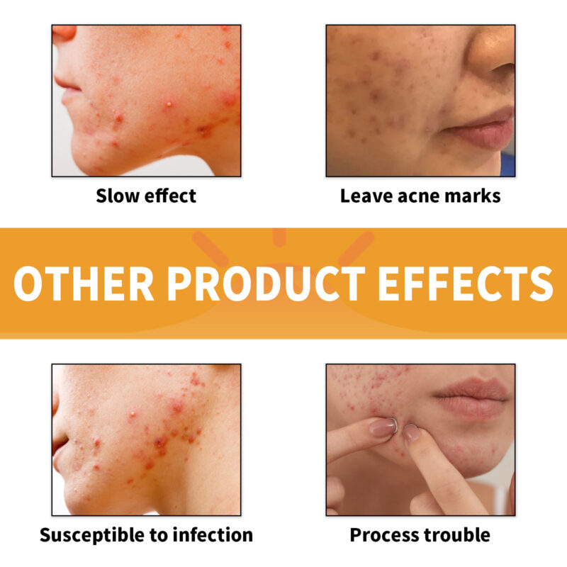 Hydrocolloidal Acne Patches for Chin - Absorbs Impurities, Skin Protection, Portable Design - Image 3