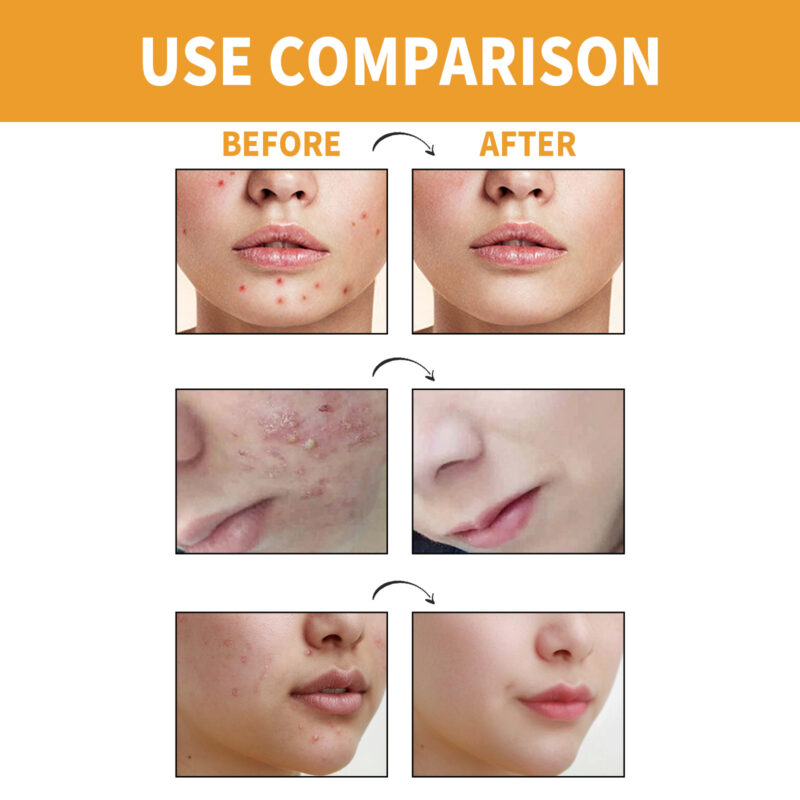 Hydrocolloidal Acne Patches for Chin - Absorbs Impurities, Skin Protection, Portable Design - Image 4