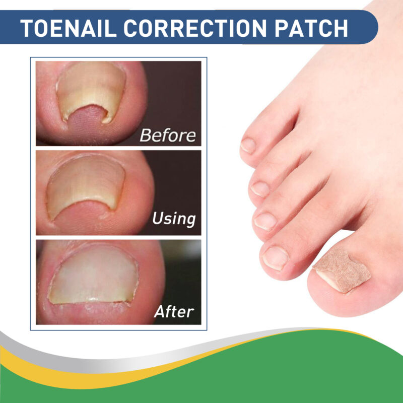 Toenail Correction Patch - Gentle Alignment for Natural Nail Care - Image 4